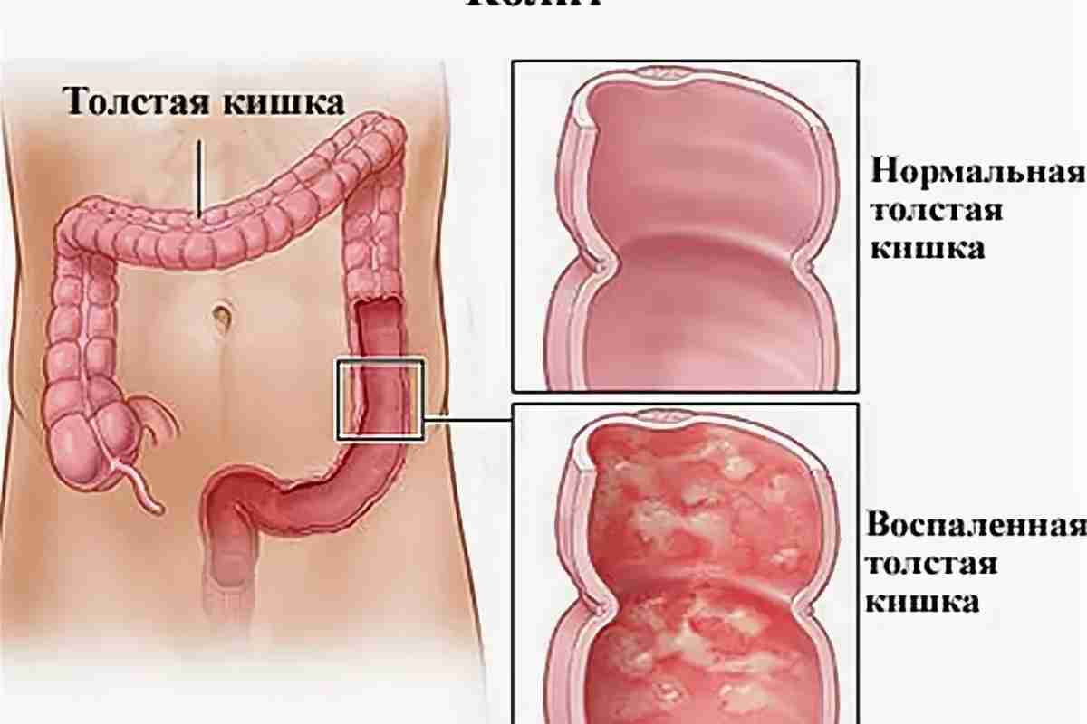 Гострий і хронічний коліт кишечника: лікування обох форм захворювання