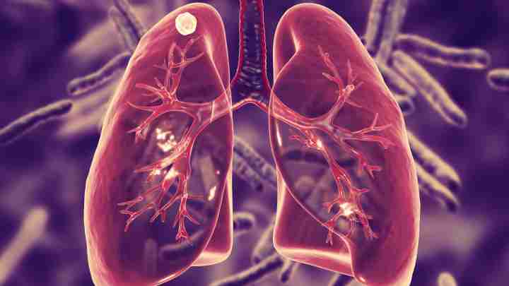 Туберкульоз: шляхи зараження. Туберкульоз легенів: ознаки та шляхи зараження