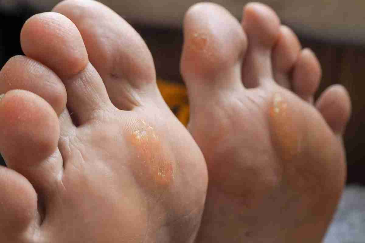 Мозоль між пальцями ноги: лікування народними засобами. Сухі мозолі між пальцями ніг: лікування