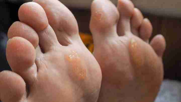 Мозоль між пальцями ноги: лікування народними засобами. Сухі мозолі між пальцями ніг: лікування