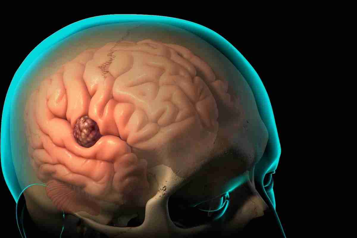 Набряк мозку: причини і наслідки. Набряк головного мозку у дітей і дорослих