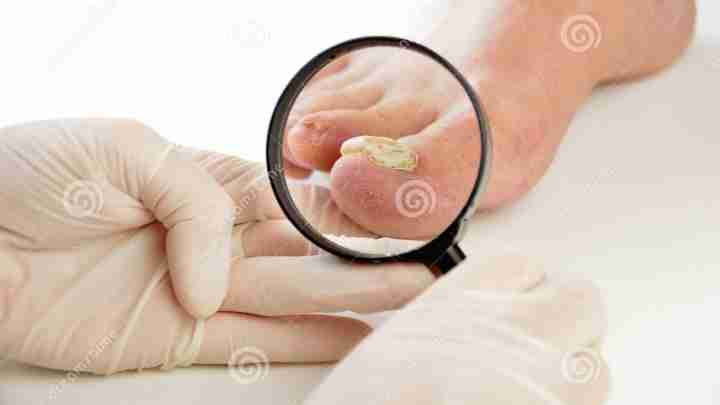 Грибкові захворювання шкіри: симптоми і лікування. Медикаментозні та народні засоби
