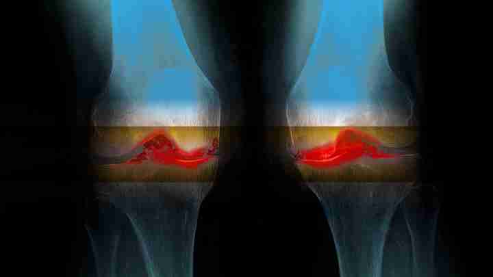 Артроз 3 ступеня колінного суглоба: лікування, причини, профілактика