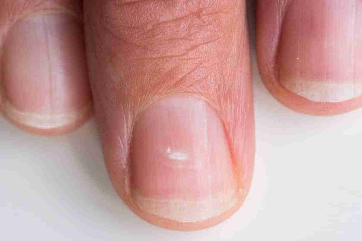 Білі плями на нігтях пальців рук: як лікувати?