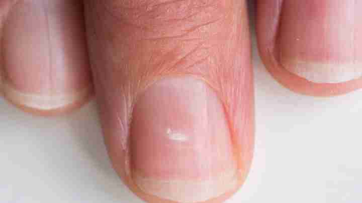 Білі плями на нігтях пальців рук: як лікувати?