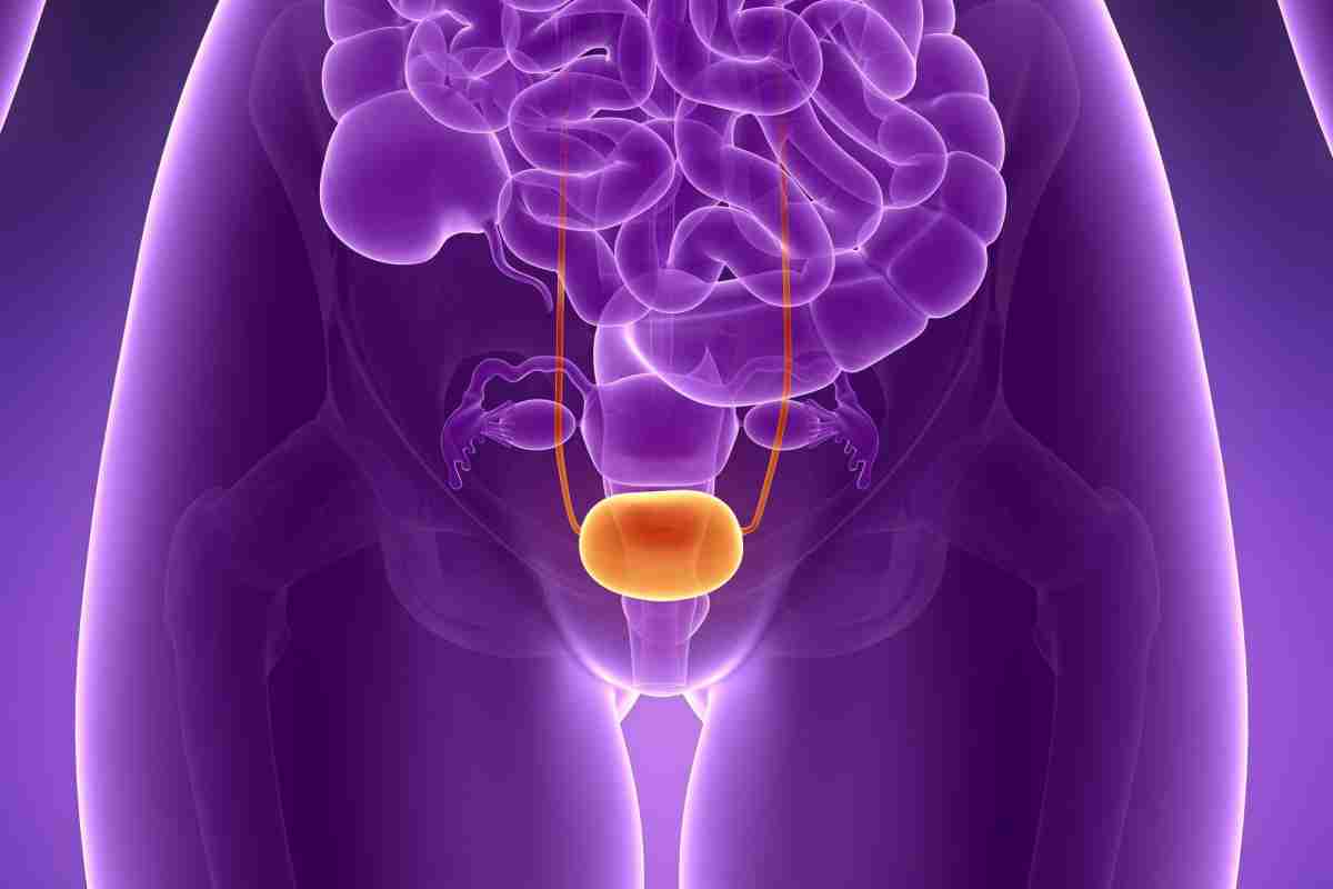 Поліп у сечовому міхурі у жінок: симптоми, причини та методи лікування