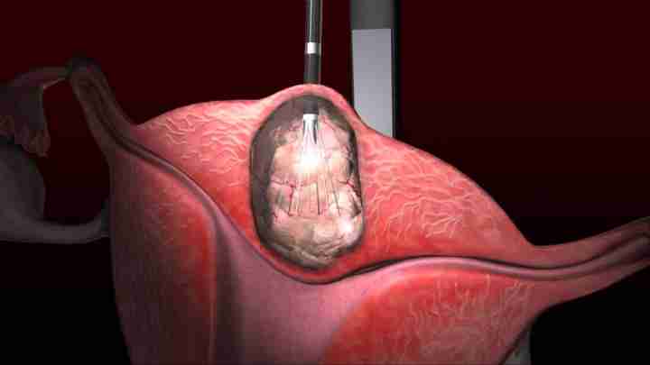 Ендометрій гравідарний: причини появи, симптоми і лікування