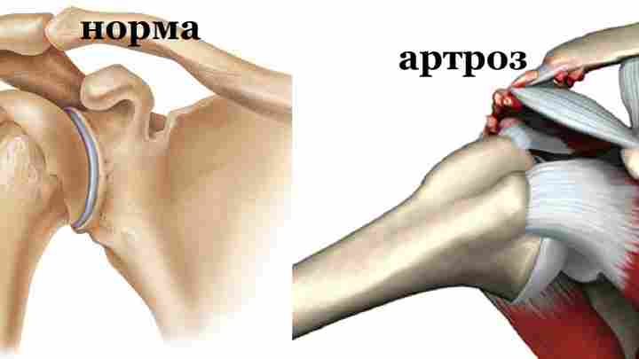 Вивих плечового суглоба: види, причини, симптоми, лікування