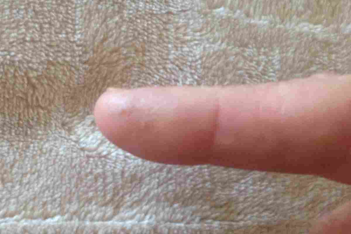 Наріст на пальці руки: що це може бути? Чому на пальцях рук з 'являються нарости?