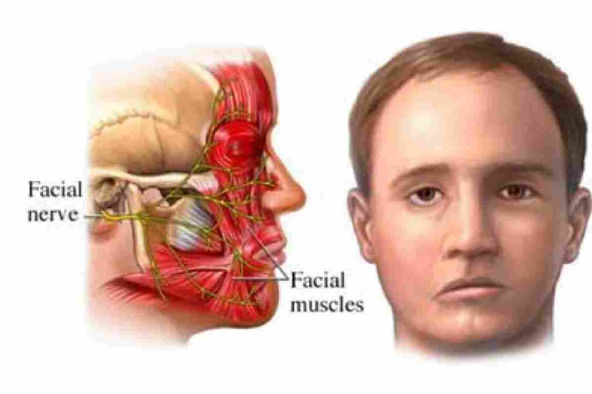 Лицьовий нерв, запалення: симптоми, лікування. Як розпізнати неврит лицьового нерва