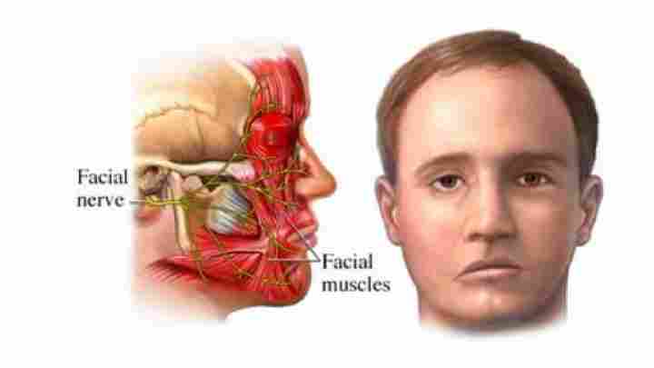 Лицьовий нерв, запалення: симптоми, лікування. Як розпізнати неврит лицьового нерва