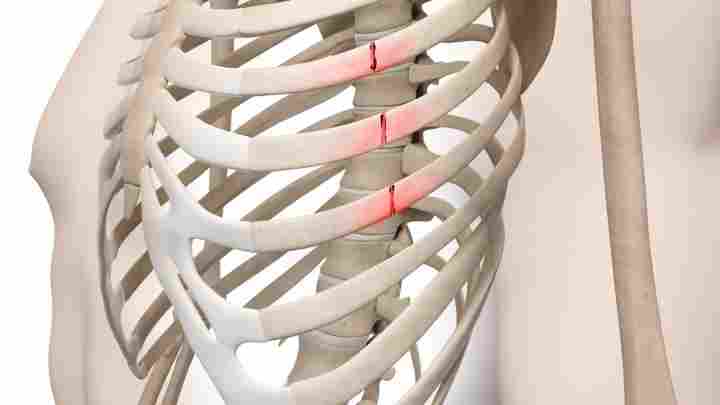 Перелом ребра: лікування в домашніх умовах ліками та народними засобами