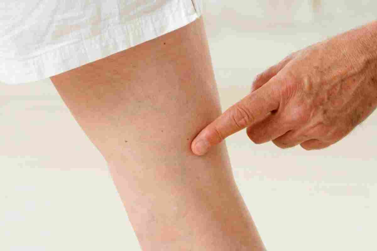 Болять вени на ногах: що робити, чим лікувати?