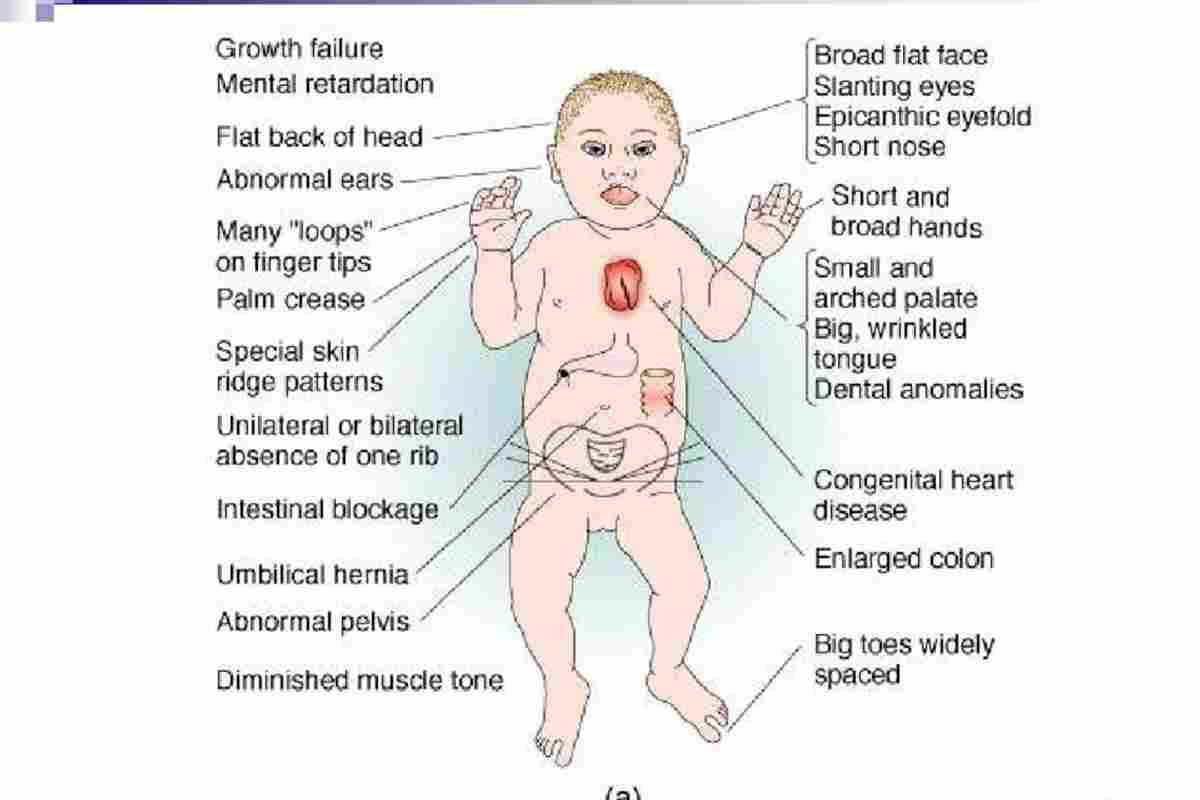 Синдром Дауна: ознаки при вагітності, причини