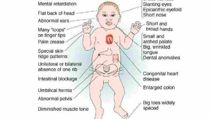 Синдром Дауна: ознаки при вагітності, причини