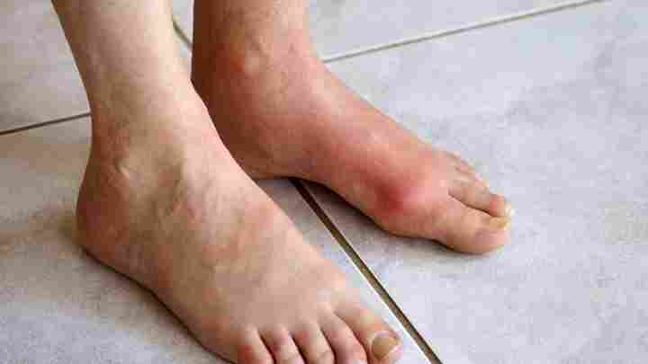 Запалення суглобів великих пальців ніг: симптоми і лікування