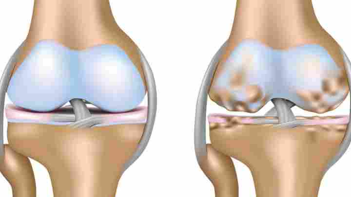 Дієта при артрозі колінних суглобів: рекомендації