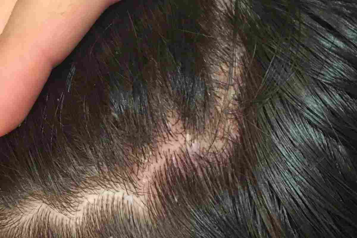 Гіперкератоз шкіри голови: причини, лікування