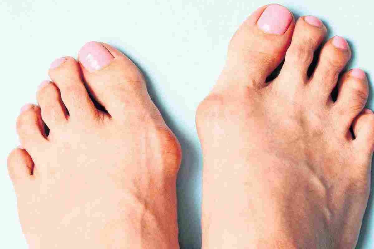 Лікування шишок на ногах у великого пальця без операції