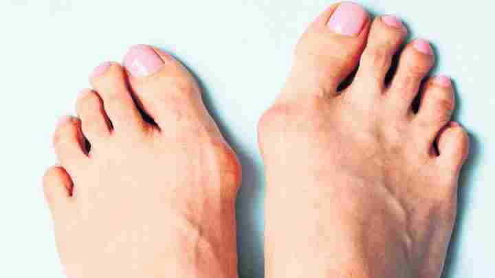 Лікування шишок на ногах у великого пальця без операції