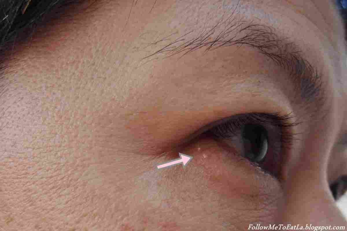 Жировики на обличчі: причини виникнення та лікування