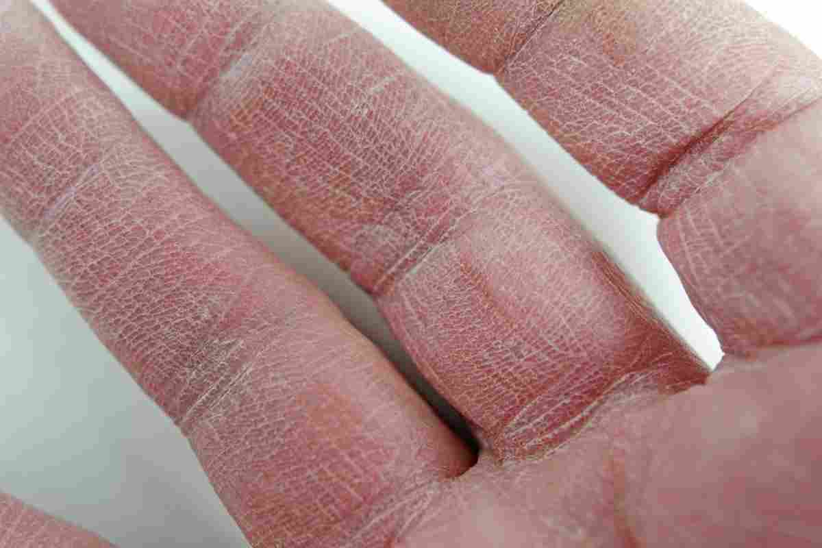 Чому облазить шкіра на пальцях, і до якого лікаря йти?