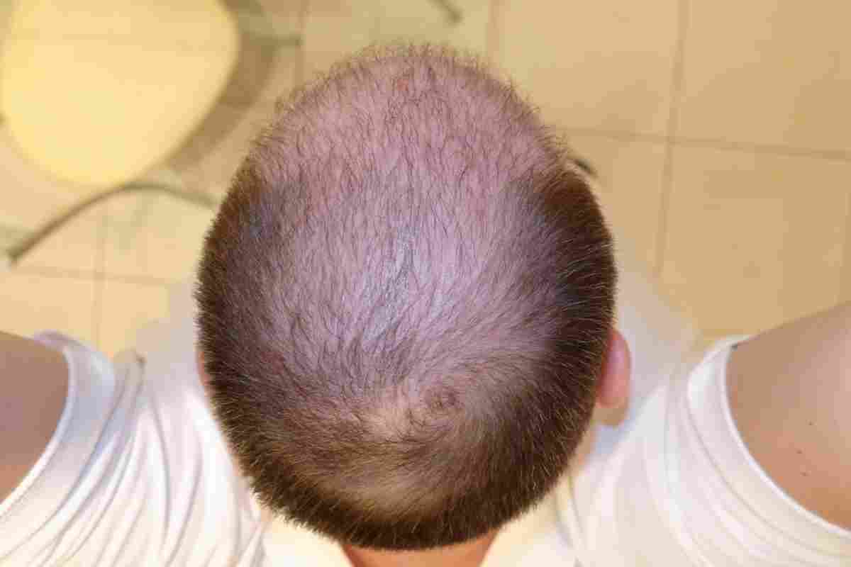 Осередкова алопеція - чому розвивається гніздне випадання волосся, і як з цим боротися?