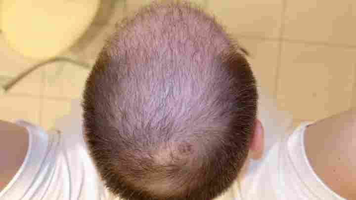 Осередкова алопеція - чому розвивається гніздне випадання волосся, і як з цим боротися?