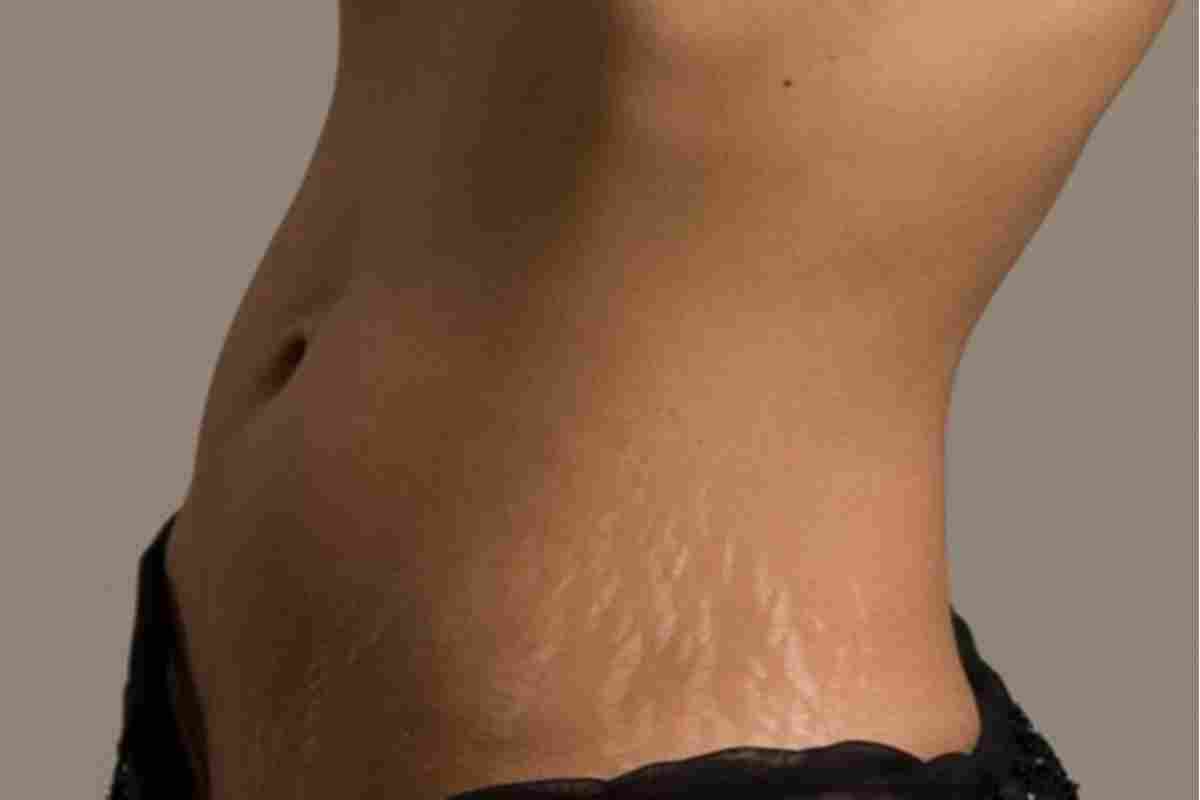 Як позбутися розтяжок на грудях?