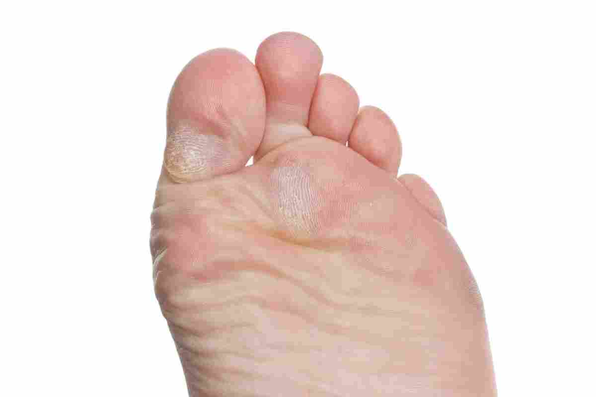 Натоптиші на пальцях ніг - як позбутися?