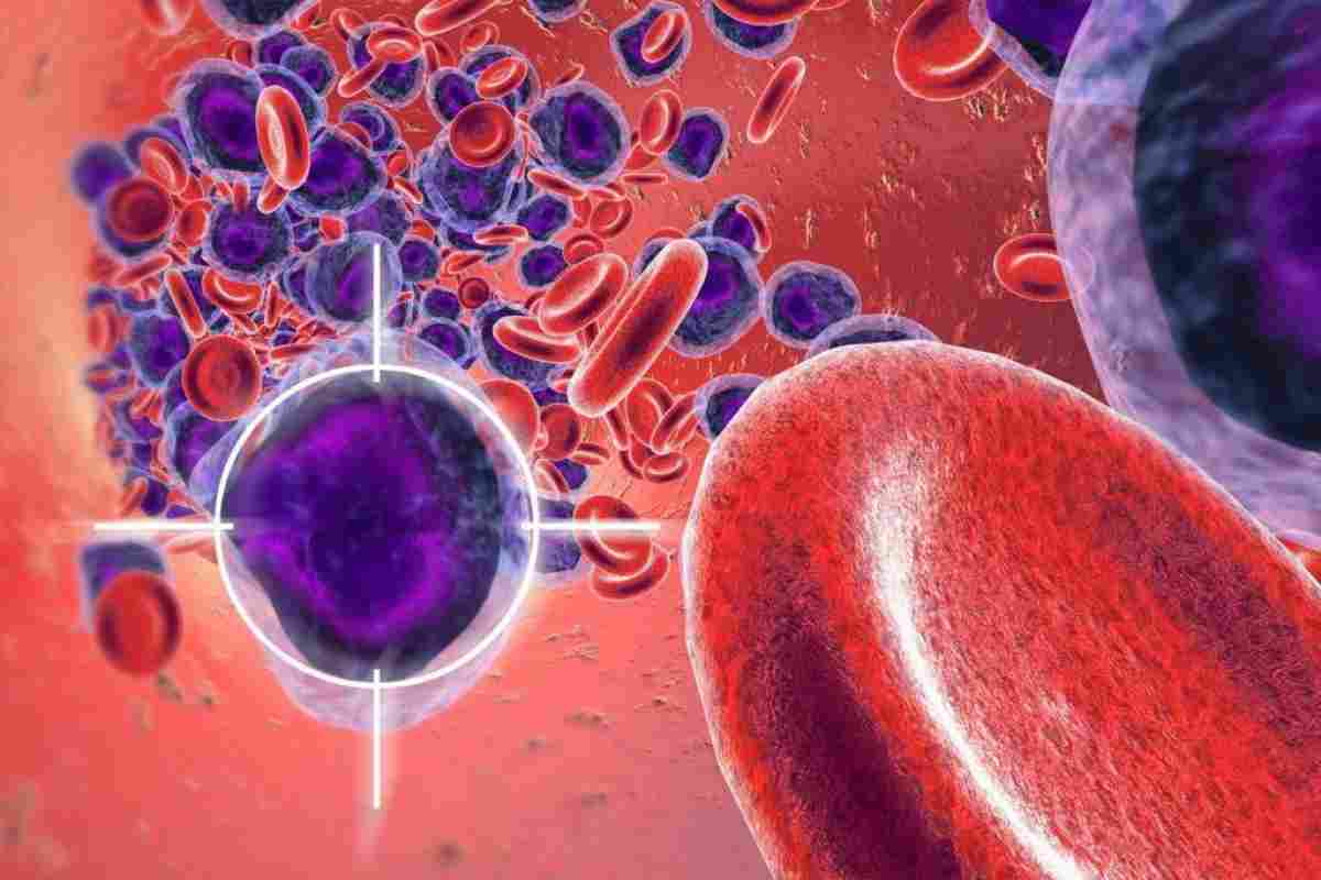 Рак крові - симптоми у жінок усіх видів лейкозу