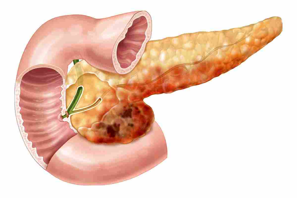 Рак підшлункової залози - симптоми, які важливо помітити вчасно