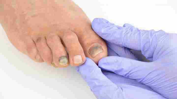 Лікування грибка нігтів - кращі методи усунення онихомикоза