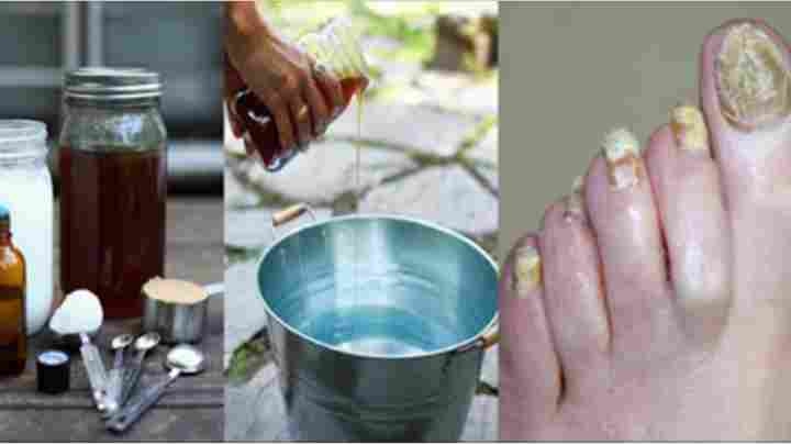 Грибок нігтів - лікування йодом, 7 перевірених рецептів