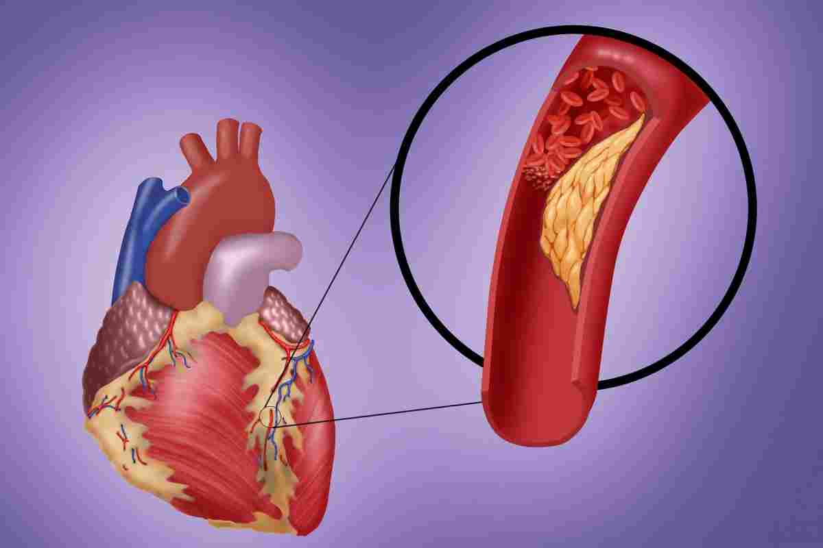 Ішемічна хвороба серця - всі причини розвитку хвороби і краще в лікуванні