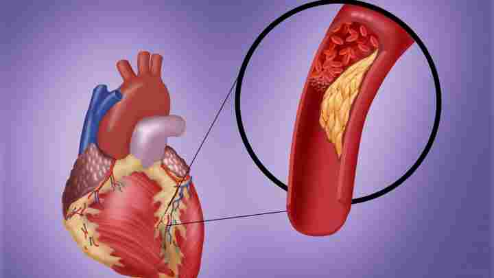 Ішемічна хвороба серця - всі причини розвитку хвороби і краще в лікуванні