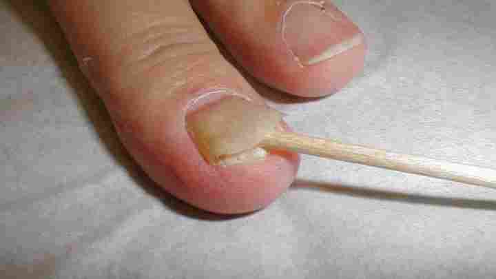 Розшарування нігтів - причина і лікування