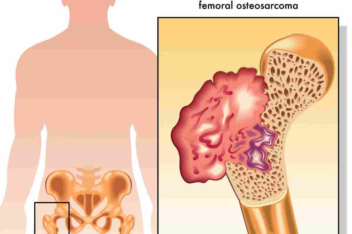 Рак кісток - види пухлин, симптоми і методи лікування