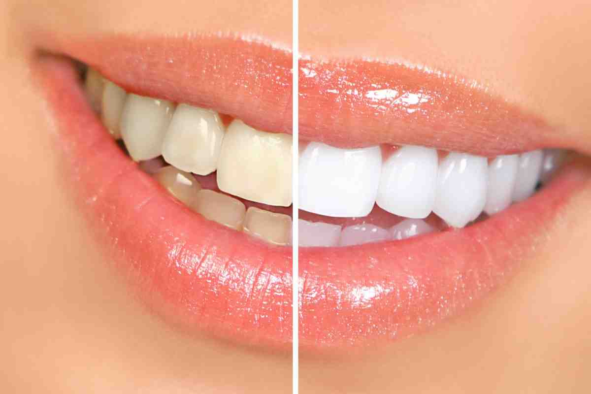 4 речі, які треба знати про відбілювання зубів