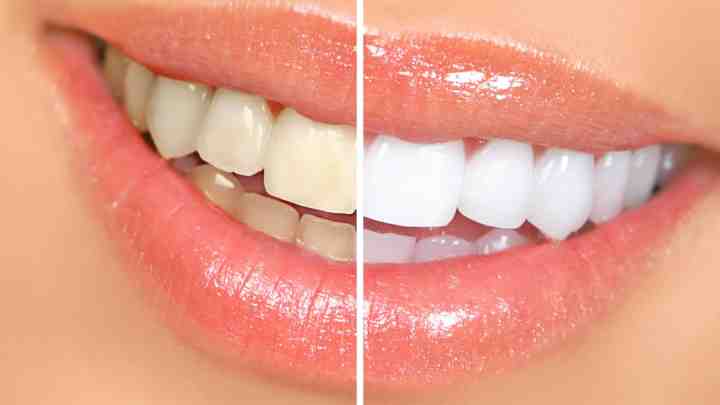4 речі, які треба знати про відбілювання зубів