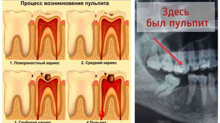Що можна прикласти до хворого зуба
